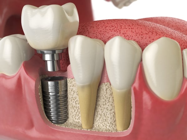 dental implant problems