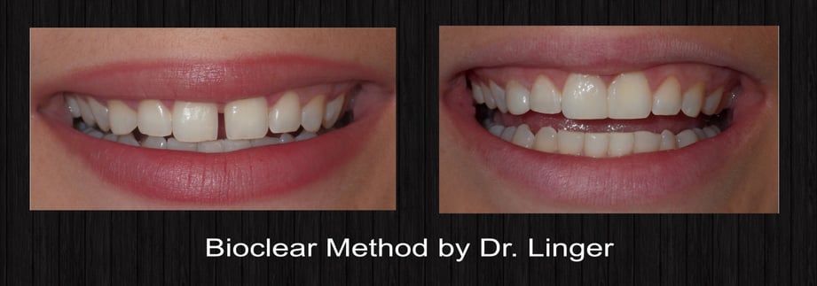 Diastema Closure