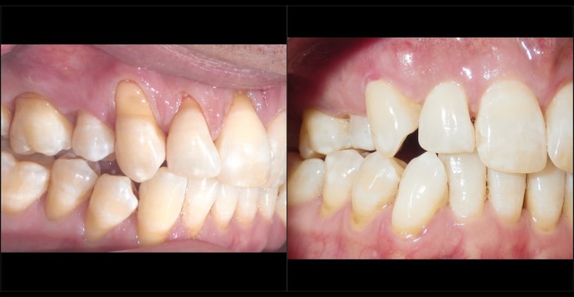 pinhole surgery results