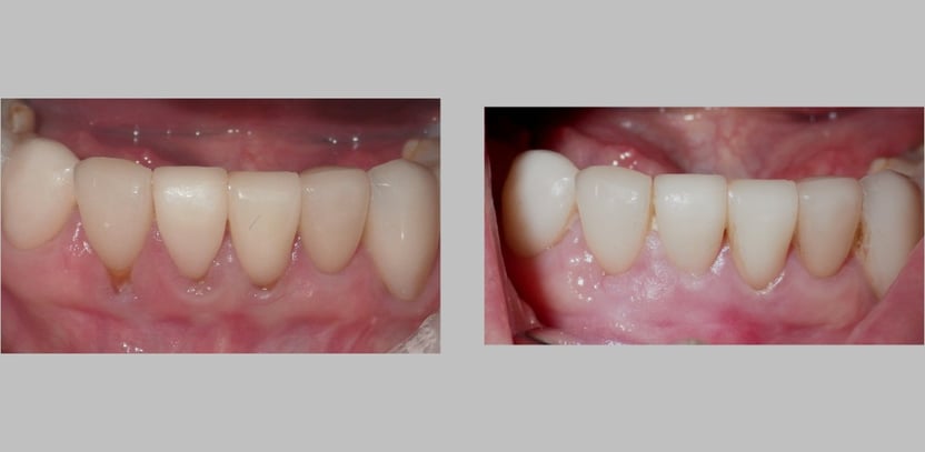 pinhole before and after