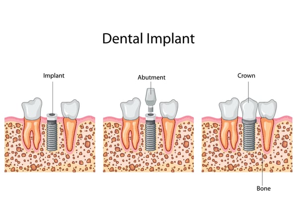 what are dental implants