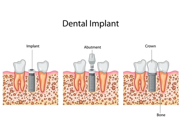 what is a dental implant