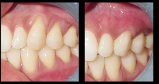 pinhole surgery