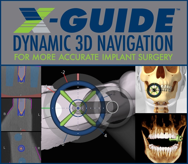 X-Guide guided dental implants