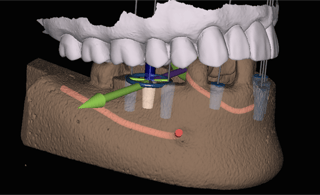 X-Guide implant plan