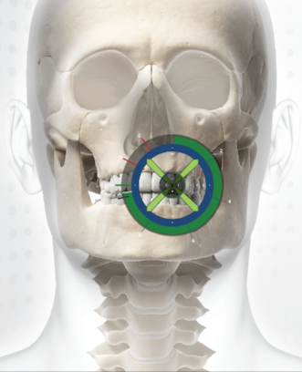 guided dental implants