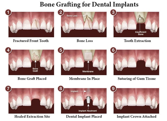 bone graft for dental implants procedure
