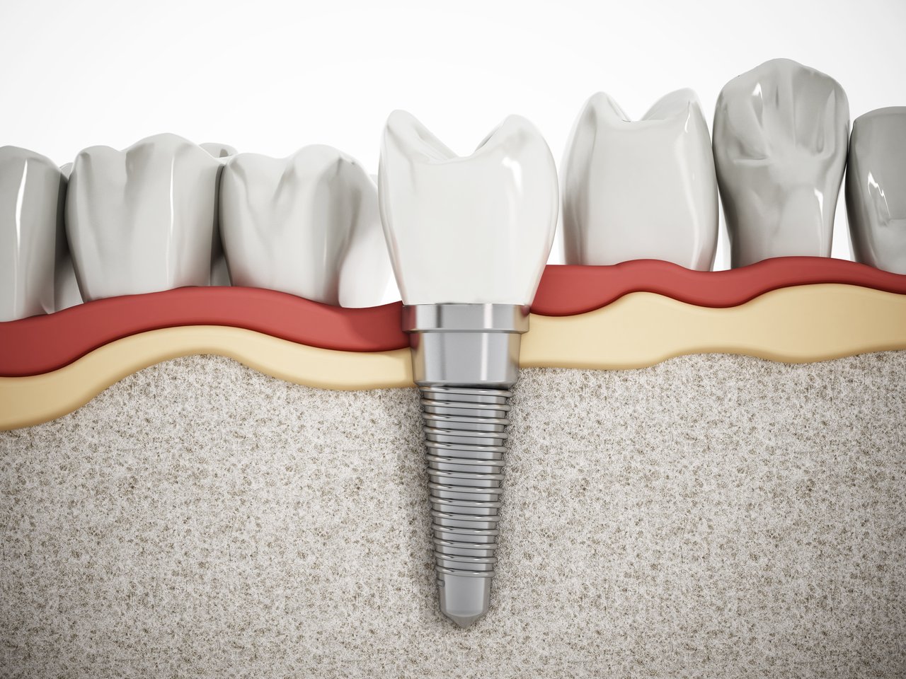 How to Know When to Use a Dental Implant