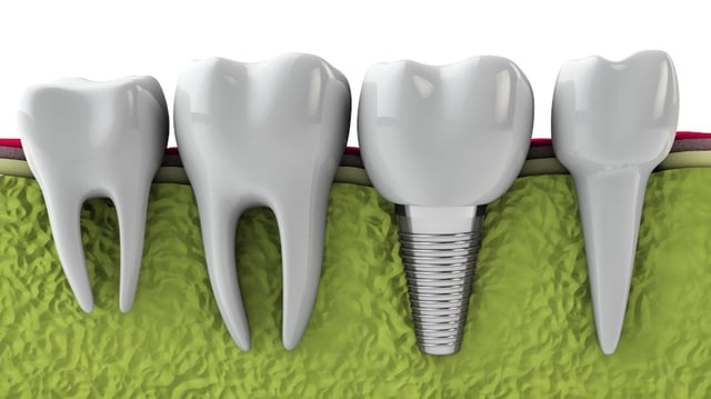dental implants are important