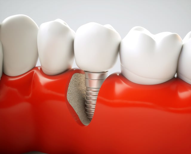 treating tooth loss with dental implants