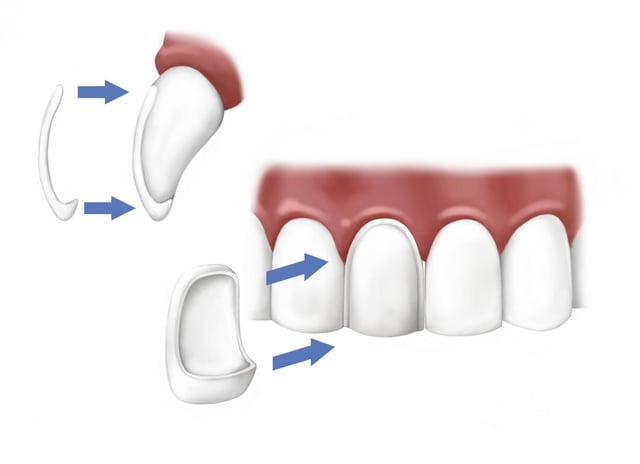 porcelain veneers