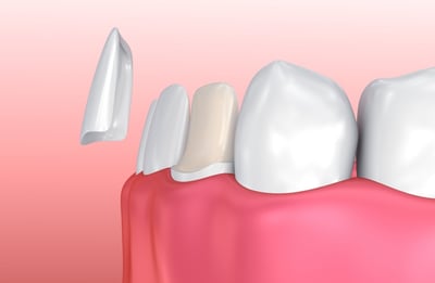 veneer to repair teeth