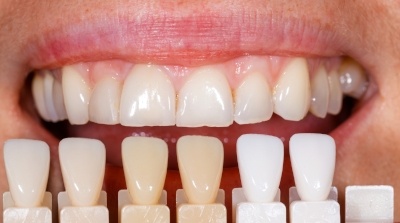 cosmetic dental teeth whitening