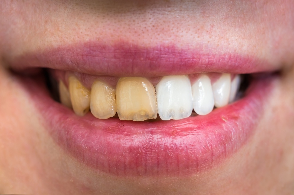 5 Signs That Your Teeth May Need Whitening in Charlotte NC.