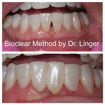 Bioclear correction of black triangle