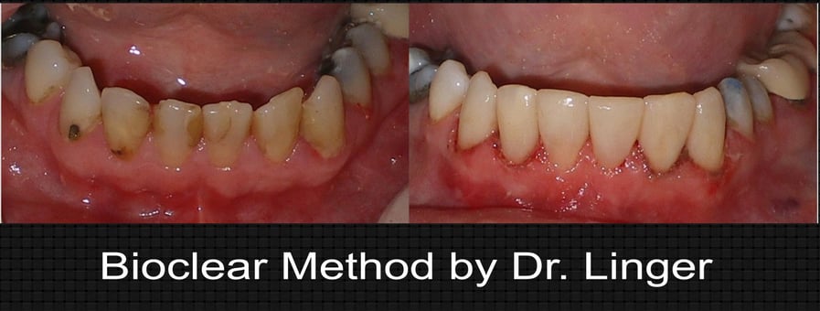 bioclear lower anterior