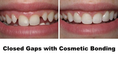 what is cosmetic dental bonding