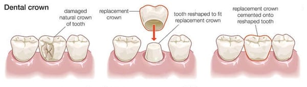 crown to fix chipped tooth