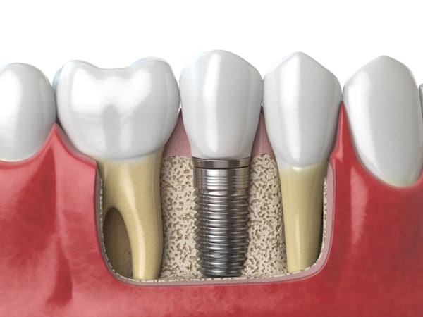 questions people have about dental implants