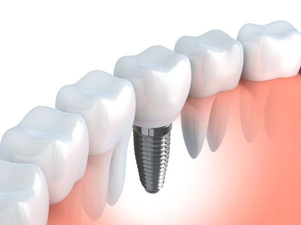 why you will love dental implants