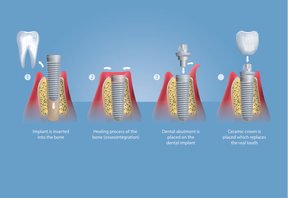 Should You Consider Dental Implants?