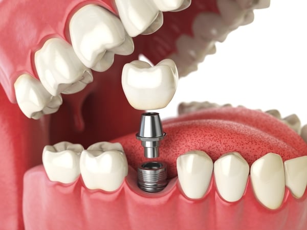 dental implant to fix chipped tooth