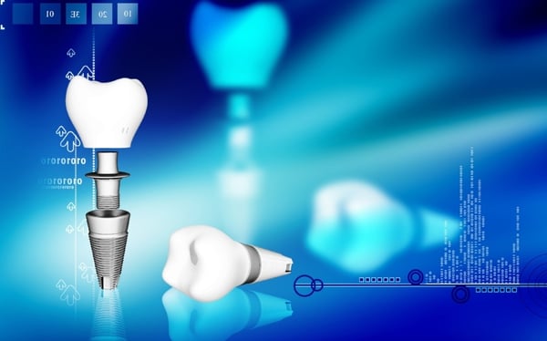 What are dental implants