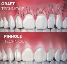 alternative to gum grafting