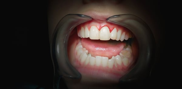 receding gums