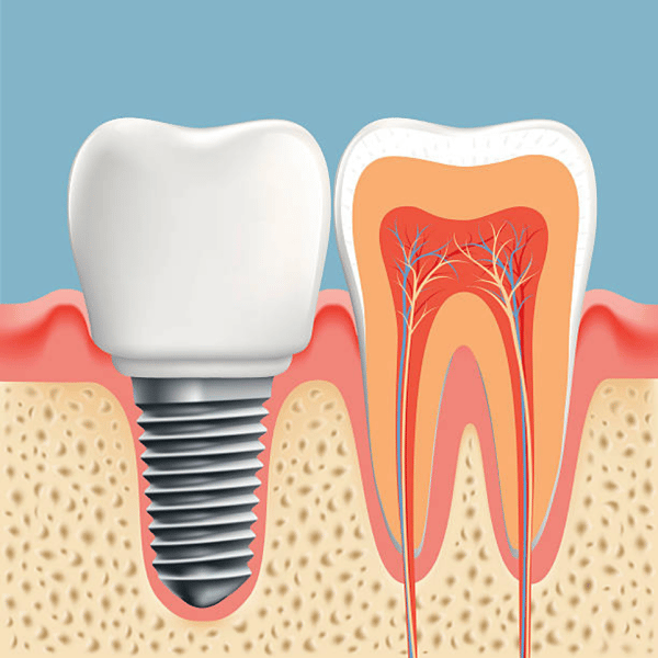 dental implant care