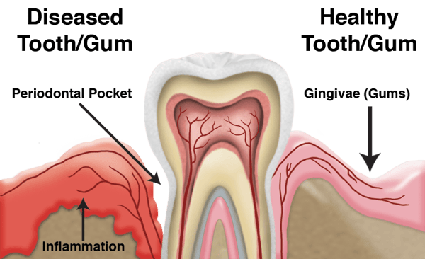 periodontal gum treatment