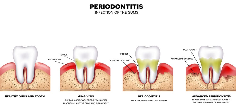 periodontal gum treatment