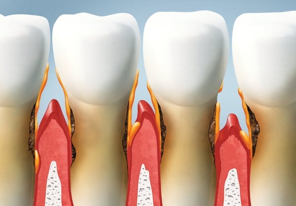 treatment for periodontitis