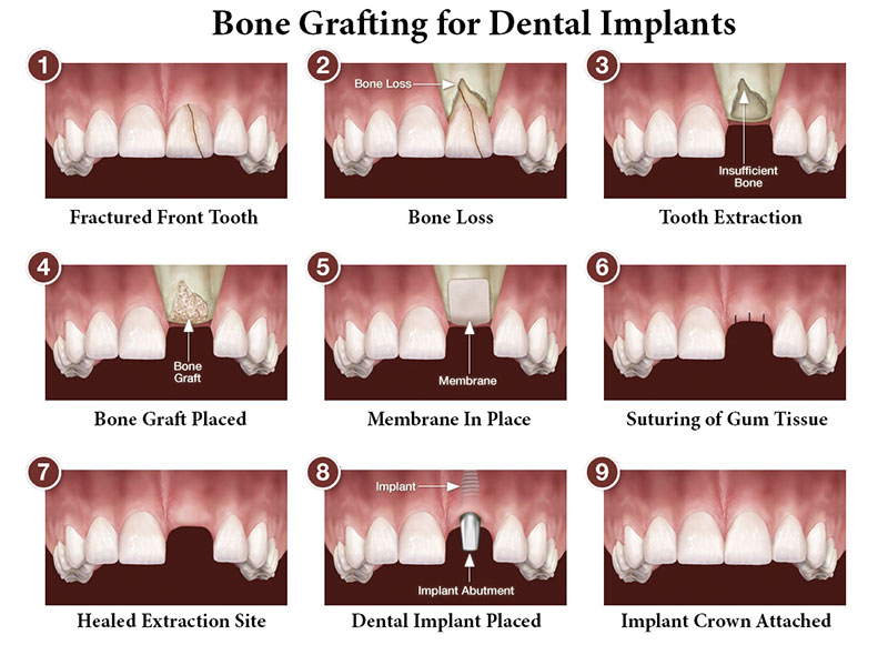 Bone Grafting William Linger Dds Magd