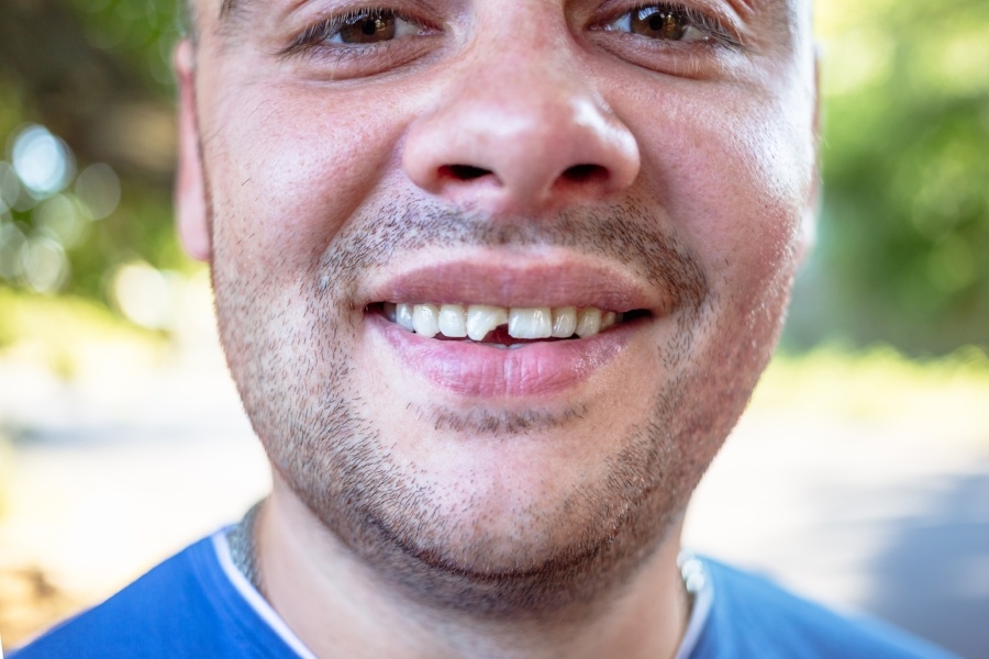 What Can Be Done To Fix A Chipped Tooth What Is Right For Me 