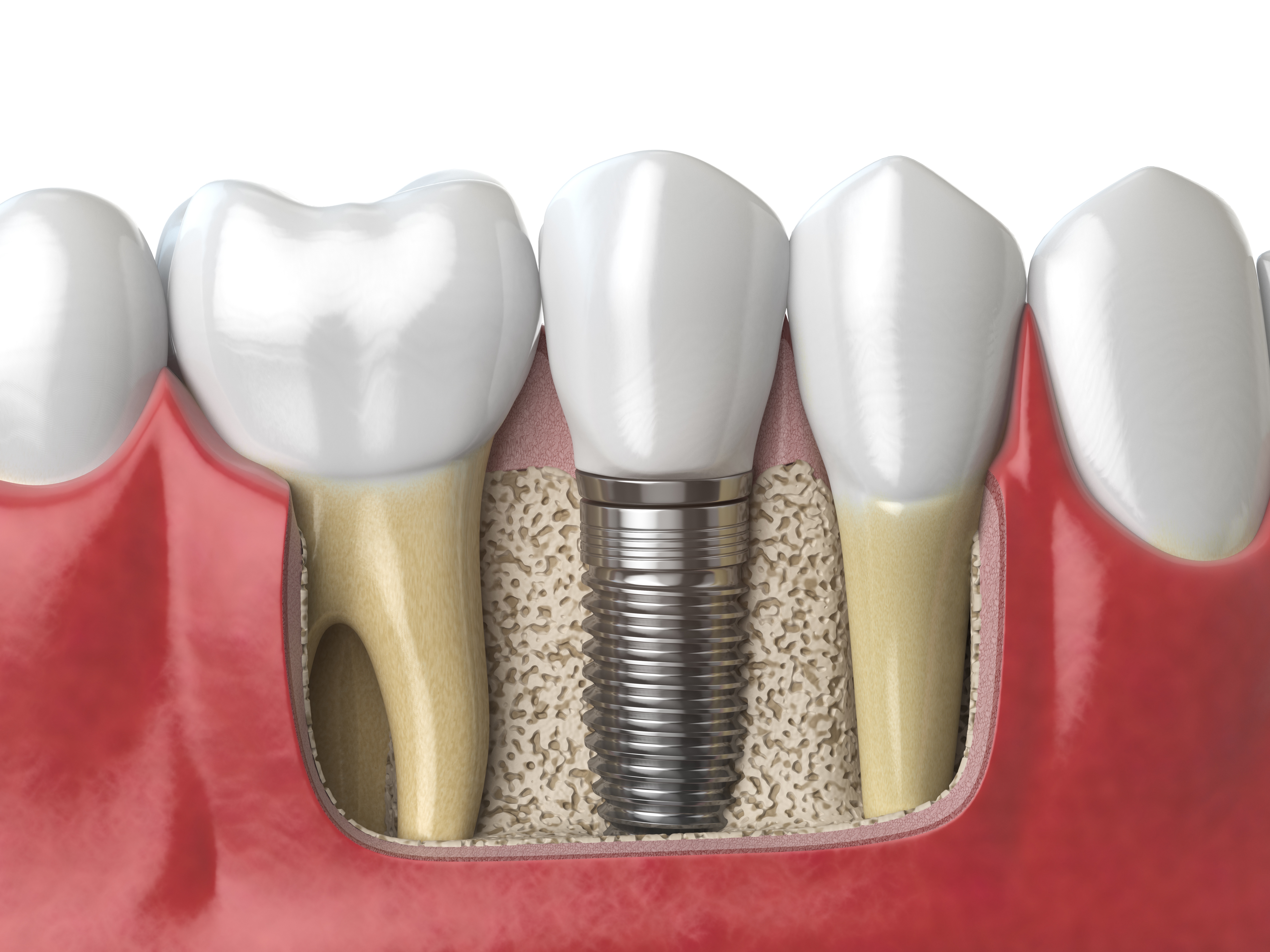 Dental Implant Charlotte NC William Linger, DDS, MAGD